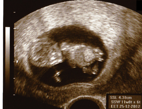 Baby in der 12. Woche Ultraschall